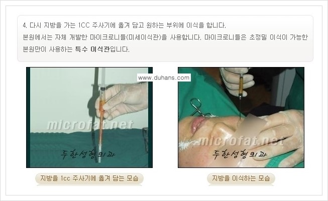 [두한성형외과 경쟁력 미세지방이식] - [귀족수술과 인디언밴드 교정 안내] 관련 이미지 5