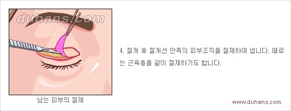 [두한성형외과 경쟁력 안검성형] - [젊고 아름다운 눈매 상안검 성형술 안내] 관련 이미지 4