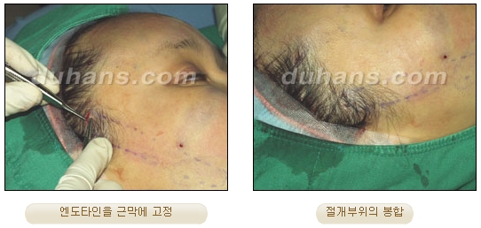[Duhan Plastic Surgery Wrinkle Removal] - [Wrinkle Removal Treatment Methods] image 43