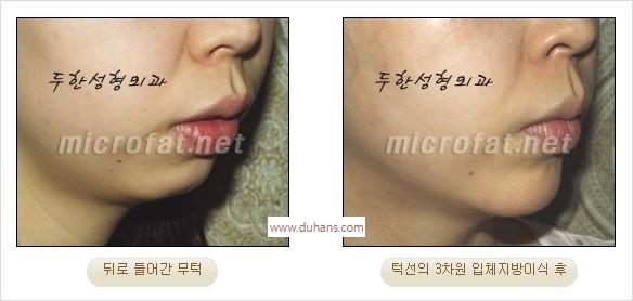 [두한성형외과 경쟁력 안면윤곽 교정] - [자연스럽고 균형있는 턱으로의 복원 미세지방이식과 간편 사각턱 보톡스 안내] 관련 이미지 16