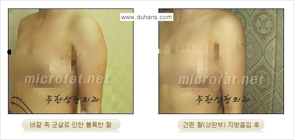 [두한성형외과 겨울엔 지방흡입 도전] - [간편한 복부지방흡입 2.] 관련 이미지 12