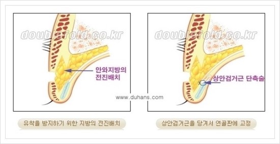 [두한성형외과 경쟁력 눈성형] - [극한 재수술, 함몰된 눈꺼풀 라인교정, 안검하수(졸리운 눈매)] 관련 이미지 92
