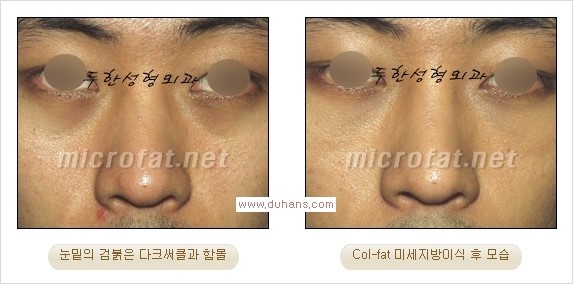 [두한성형외과 경쟁력 눈밑성형] - [눈밑이 전반적으로 함몰된 다크써클 교정 안내] 관련 이미지 6