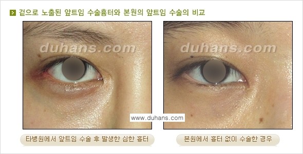 [두한성형외과 눈성형 FOCUS] - [몽고주름 제거(앞트임 제거) 수술 ①] 관련 이미지 4