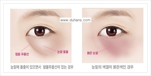 [두한성형외과 경쟁력 다크써클 교정] - [다크써클 5단계로 이뤄지는 핵심 5 STEP SOLUTION 안내 1.] 관련 이미지 3