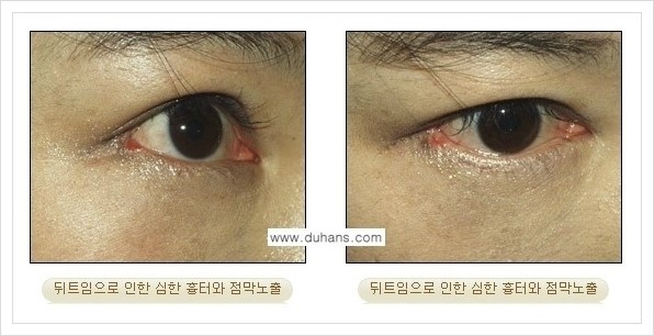 [두한성형외과 경쟁력 눈성형] - [앞트임 복원수술, 뒤트임 수술 안내] 관련 이미지 14