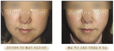 [두한성형외과 안전한 지방흡입] - [얼굴지방흡입] 관련 이미지 12