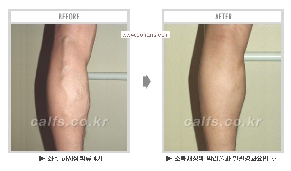 [두한성형외과 경쟁력 멀티종아리성형] - [지방흡입이 필요한 종아리 비만 안내] 관련 이미지 19