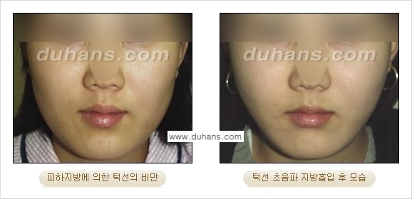 ​​​﻿[두한성형외과 경쟁력 간편지방흡입] - [볼살지방흡입, 턱선지방흡입 안내] 관련 이미지 3