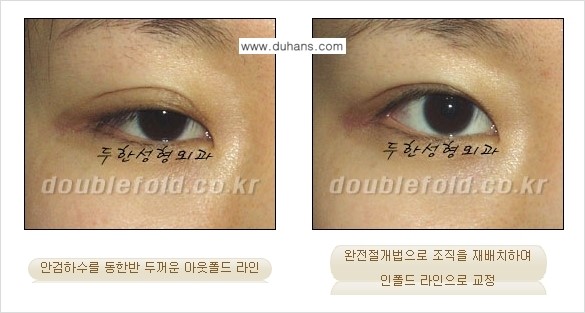 [두한성형외과] - [아웃폴드를 인폴드로 변화시키는 쌍꺼풀재수술] 관련 이미지 11
