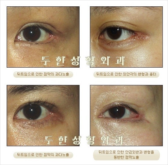 [두한성형외과] - [뒤트임 수술은 절대로 해서는 안 될 수술입니다.] 관련 이미지 1