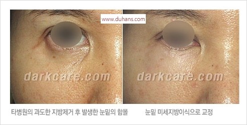 ⁠⁠[두한성형외과 경쟁력 안검성형] - [젊은 눈매를 위한 윗눈꺼풀 지방제거, 눈밑 지방제거] 관련 이미지 40
