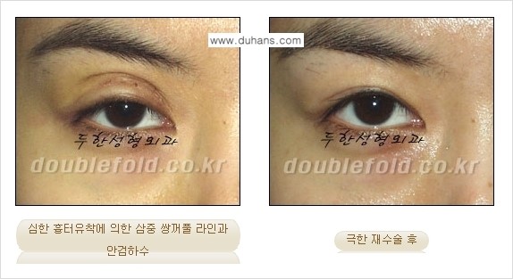 [두한성형외과 경쟁력 쌍꺼풀 재수술] - [망가진 쌍꺼풀 라인을 교정하는 극한재수술 ①] 관련 이미지 10