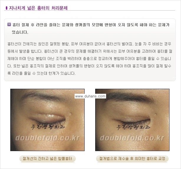 [두한성형외과 경쟁력 있는 쌍꺼풀 재수술] - [극복해야 할 극한의 상황과 문제들] 관련 이미지 4