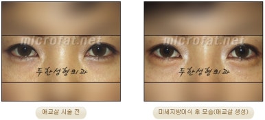 두한성형외과 눈밑성형 - 애교필러 후 눈밑재수술 관련 이미지 17