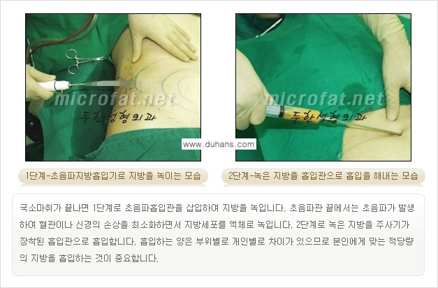 [두한성형외과 간편 지방흡입] - [복부지방흡입 안내 2.] 관련 이미지 7