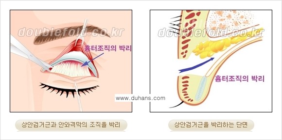 [두한성형외과 경쟁력 눈성형] - [안검하수 수술 방법] 관련 이미지 2