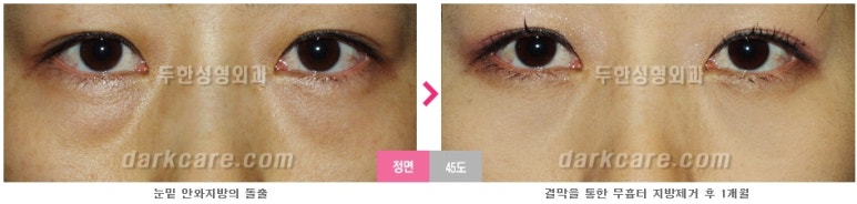 [두한성형외과 다크서클] - [다크서클 전후사진 검증] 관련 이미지 98