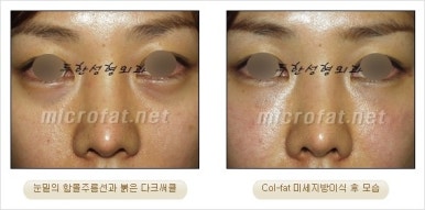 두한성형외과 눈밑수술 - 다크서클 수술 전후 관리 안내 관련 이미지 17