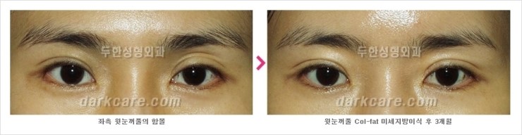 [두한성형외과 경쟁력 눈밑 다크써클 치료] - [눈밑 다크써클과 눈위 지방이식 콤비 프로그램 안내] 관련 이미지 13