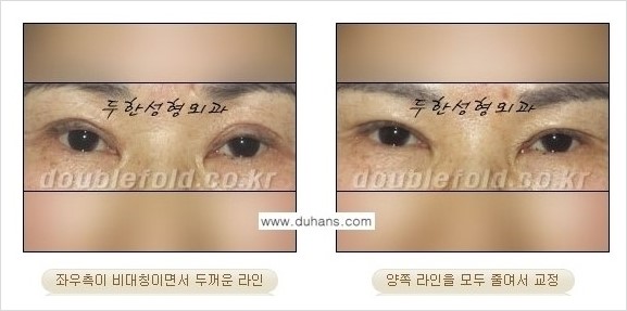 [두한성형외과 경쟁력 쌍꺼풀 재수술] - [짝짝이 쌍꺼풀 라인 교정] 관련 이미지 6