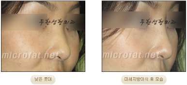 [Duhan Plastic Surgery Facial Fat Grafting] - [Fat Grafting Rhinoplasty] image 18