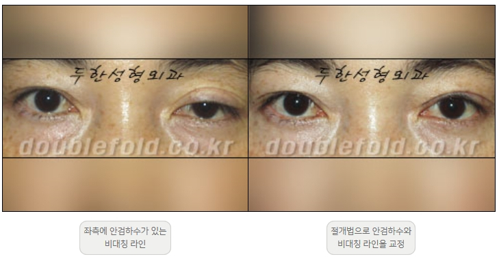 [Ptosis, Duhan Plastic Surgery] - [Sleepy-Looking Eyes, Ptosis Eye Correction] image 21