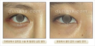 쌍커풀수술 두한성형외과 - 나에게 맞는 눈성형은? 관련 이미지 49