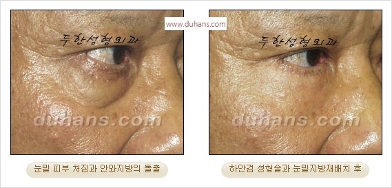 [두한성형외과 경쟁력 안검성형] - [눈밑주름 제거수술] 관련 이미지 11
