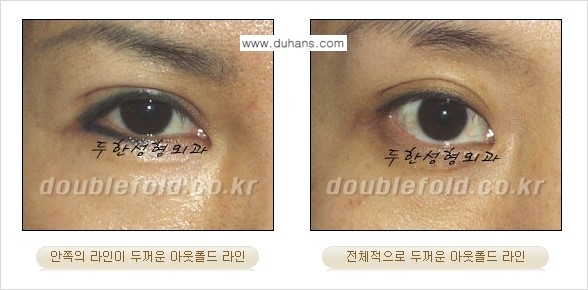 [두한성형외과 경쟁력 쌍꺼풀 재수술, 극한 눈재수술] - [심한 아웃폴드 라인을 인폴드 라인으로 교정 방법 안내] 관련 이미지 1