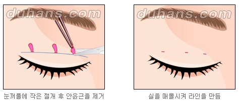 [두한성형외과 쌍커풀수술] - [눈성형 방법에 대한 자주하는 질문과 답변] 관련 이미지 5