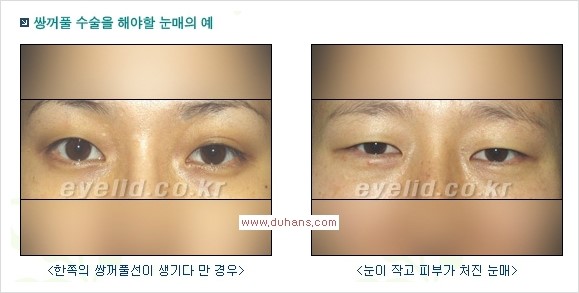 [두한성형외과 경쟁력 눈성형, 쌍꺼풀 수술] - [퀵쌍꺼풀(부분절개법)의 수술 안내] 관련 이미지 1