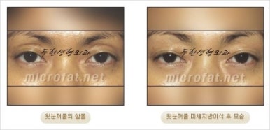 [두한성형외과 얼굴자가지방이식] - [지방이식 과정] 관련 이미지 29