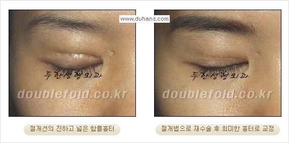 ⁠⁠[두한성형외과 경쟁력 쌍꺼풀 재수술] - [재수술 대상과 재수술의 문제점] 관련 이미지 14