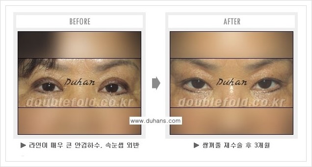 [두한성형외과 경쟁력 쌍꺼풀 재수술(극한 재수술)] - [눈매교정이 과한 경우의 문제 안내] 관련 이미지 5