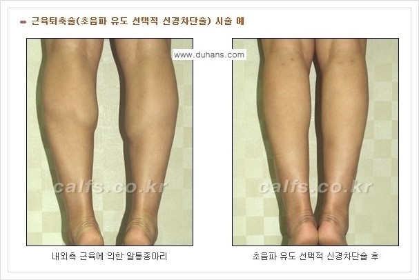 [두한성형외과 경쟁력 멀티종아리성형] - [나에게 맞는 종아리성형 방법의 종류 안내 2.] 관련 이미지 1