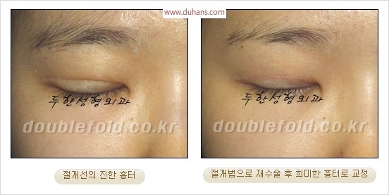 [두한성형외과 경쟁력 쌍꺼풀 재수술 리더] - [쌍꺼풀 흉터선, 쌍꺼풀 흉터 유착 교정술 안내] 관련 이미지 9