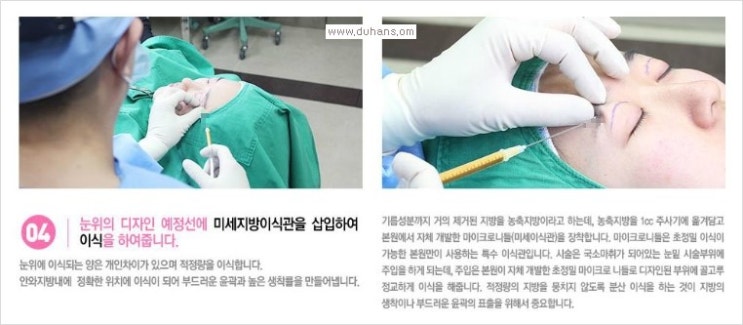 [두한성형외과 경쟁력 눈밑 다크써클 치료] - [눈밑 다크써클과 눈위 지방이식 콤비 프로그램 안내] 관련 이미지 9