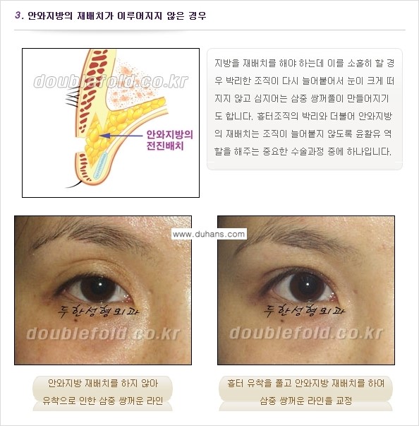 [두한성형외과 경쟁력 쌍꺼풀 재수술, 극한 눈재수술] - [쌍꺼풀 재수술, 눈 재수술의 실패 원인] 관련 이미지 3