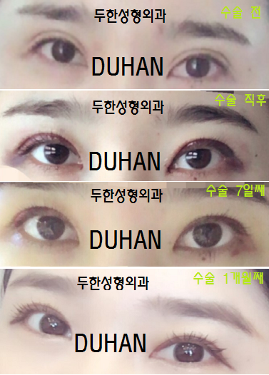 [두한성형외과 눈성형] - [몽고주름 제거, 앞트임 수술] 관련 이미지 22