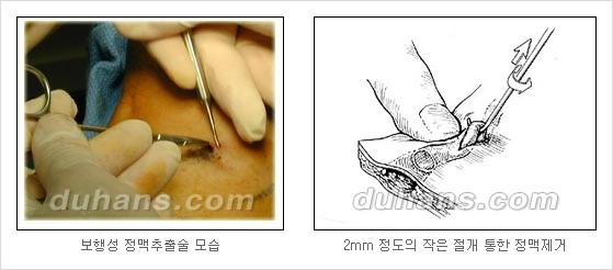 [두한성형외과 정맥류] - [하지정맥류, 정맥확장증, 혈관확장증] 관련 이미지 15