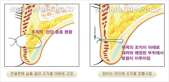 [두한성형외과 경쟁력 눈성형] - [쌍꺼풀 재수술에 대한 최선의 대안 제시] 관련 이미지 9