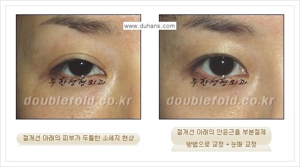 [두한성형외과 경쟁력 쌍꺼풀 재수술, 극한 재수술] - [절개선 아래가 두툼한 소세지 쌍꺼풀의 교정 안내] 관련 이미지 4