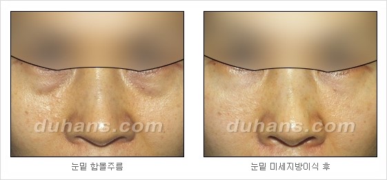[두한성형외과 경쟁력 주름성형] - [세월의 흔적! 주름을 교정하는 여러 가지 교정 방법] 관련 이미지 21