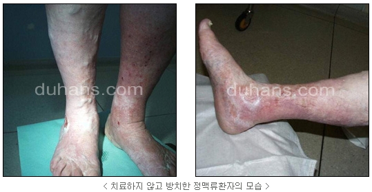 [두한성형외과 정맥류] - [하지정맥류, 정맥확장증, 혈관확장증] 관련 이미지 1