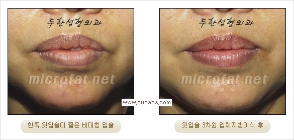 ​​​[두한성형외과 경쟁력 지방이식] - [지방이식을 이용한 입술성형 안내] 관련 이미지 17