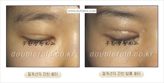 [두한성형외과 경쟁력 쌍꺼풀 재수술, 극한 눈재수술] - [쌍꺼풀 재수술 방법 - 쌍꺼풀 수술 후 흉터선이 진한 경우] 관련 이미지 2