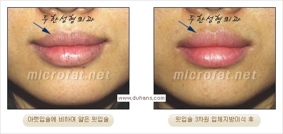 [두한성형외과 경쟁력 미세지방이식] - [입체 미세지방이식으로 주름을 펴면서 볼륨감 있는 입술 만들기] 관련 이미지 9