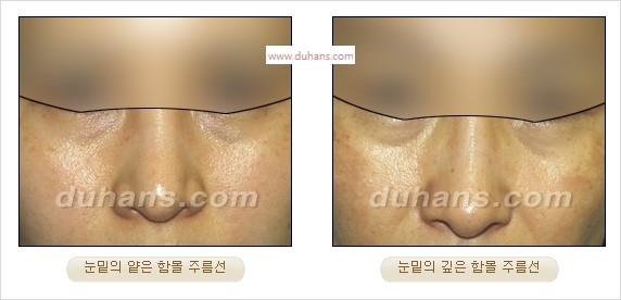 [두한성형외과 경쟁력 주름성형] - [주름제거를 위한 리프팅] 관련 이미지 7