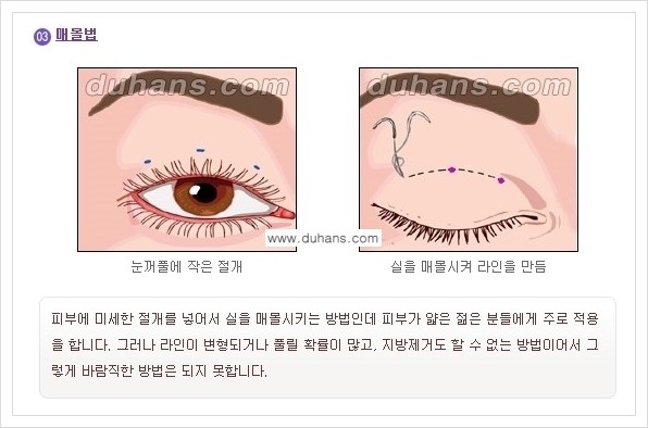 [두한성형외과 경쟁력 눈성형] - [아름다운 눈매를 쌍꺼풀수술 안내 ①] 관련 이미지 8